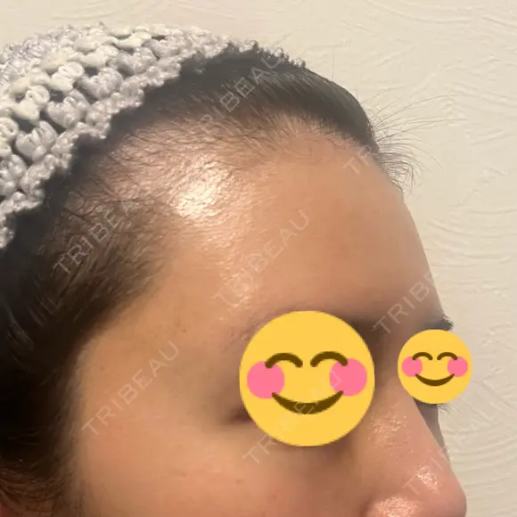 脂肪注入（額） S.T styleクリニック DAY 27 メイン用