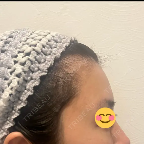 脂肪注入（額） S.T styleクリニック DAY 27 メイン用