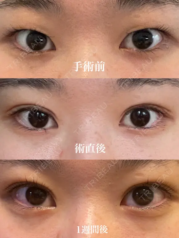 二重埋没 表参道スキンクリニック 表参道院 DAY 7 メイン用