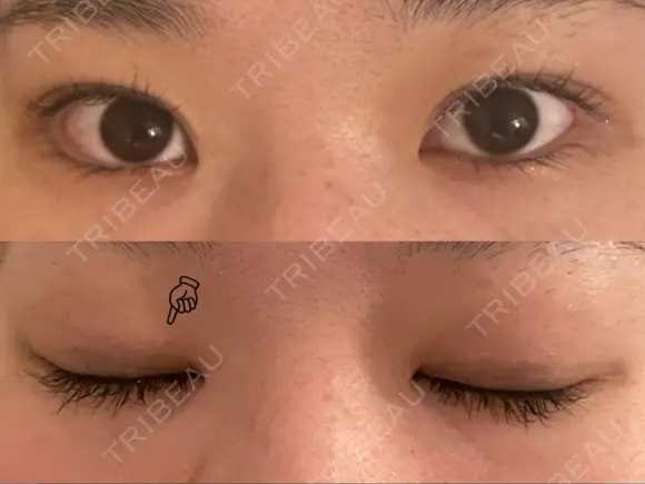 二重埋没 表参道スキンクリニック 表参道院 AFTER メイン用