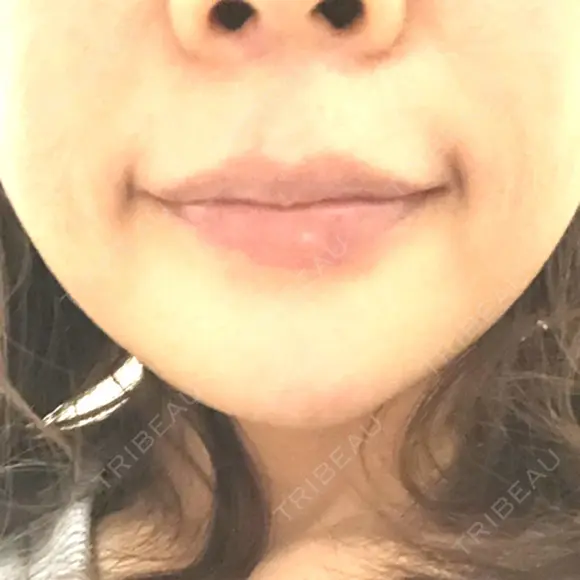 ヒアルロン酸注入（あご） TCB東京中央美容外科 世田谷院 DAY 1 メイン用