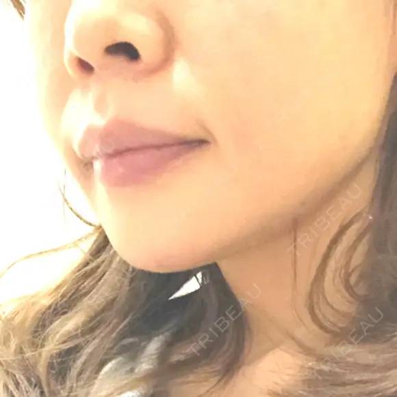 ヒアルロン酸注入（あご） TCB東京中央美容外科 世田谷院 DAY 1 メイン用
