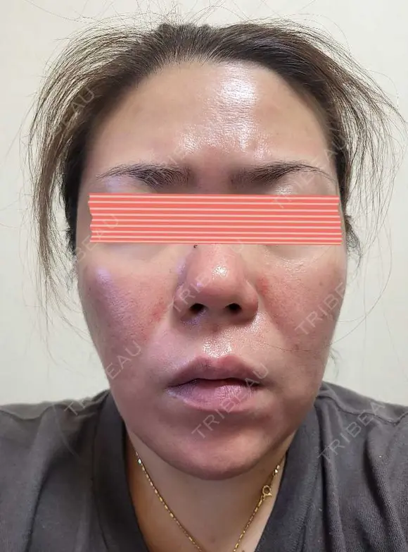 ダーマペン RAISE CLINIC 【レイズクリニック】 DAY 1 メイン用