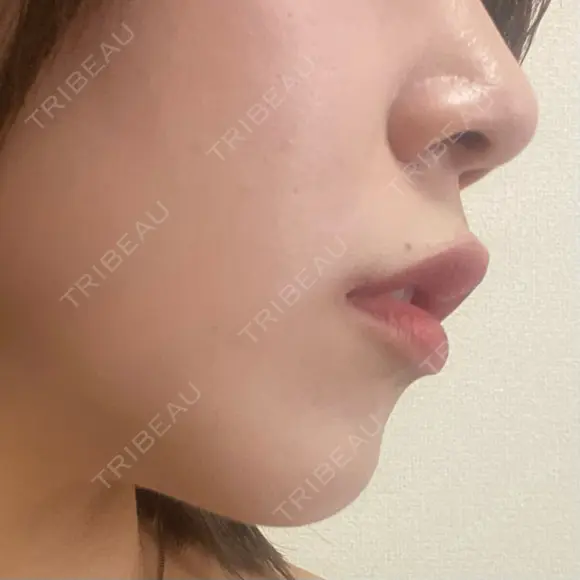 ボトックス（あご） / ボトックス（口角） / ボトックス（肩） / ボトックス（人中） EMMO FACE CLINIC 大宮院 DAY 5 メイン用