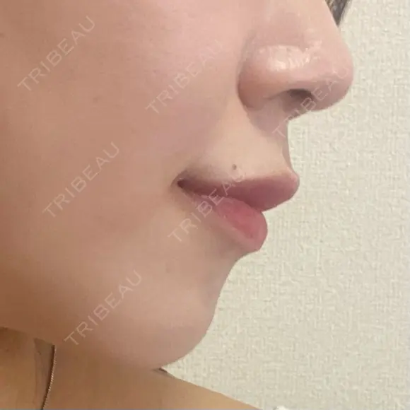 ボトックス（あご） / ボトックス（口角） / ボトックス（肩） / ボトックス（人中） EMMO FACE CLINIC 大宮院 DAY 5 メイン用