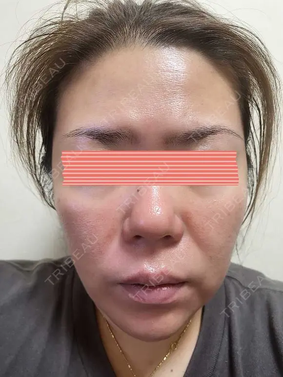 ダーマペン RAISE CLINIC 【レイズクリニック】 DAY 2 メイン用