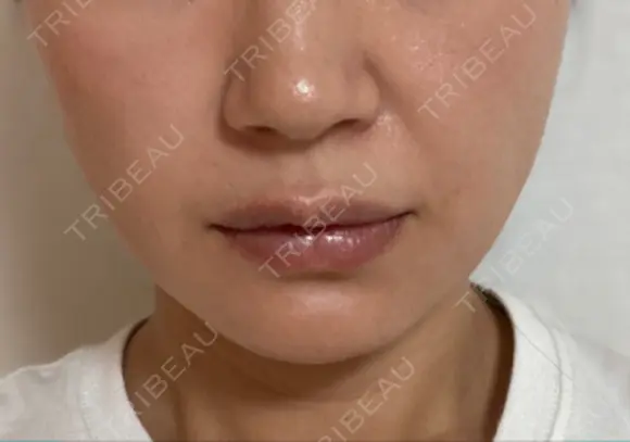 糸リフト / ヒアルロン酸注入（あご） ブルームクリニック（BLOOM CLINIC） DAY 31 メイン用