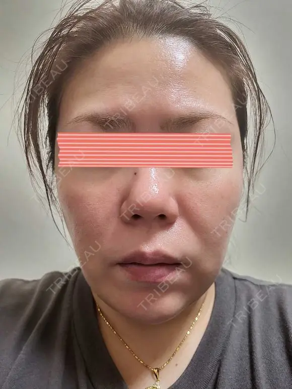 ダーマペン RAISE CLINIC 【レイズクリニック】 DAY 3 メイン用