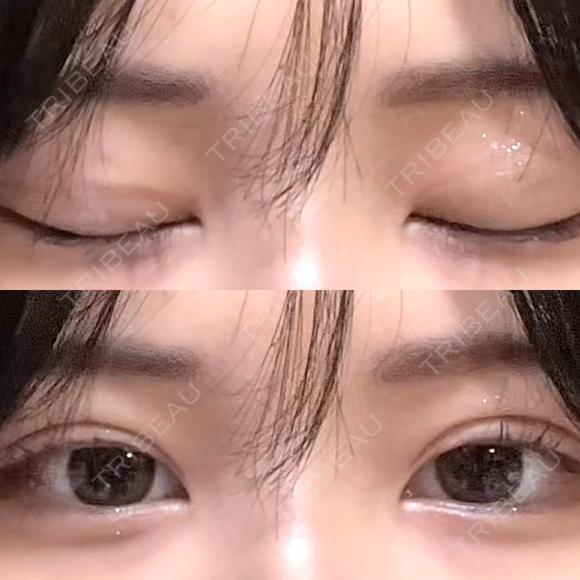 二重埋没 恵聖会クリニック 心斎橋院 DAY 21 メイン用