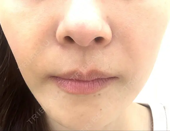 その他（肌） / エレクトロポレーション 湘南美容クリニック 静岡院 AFTER メイン用