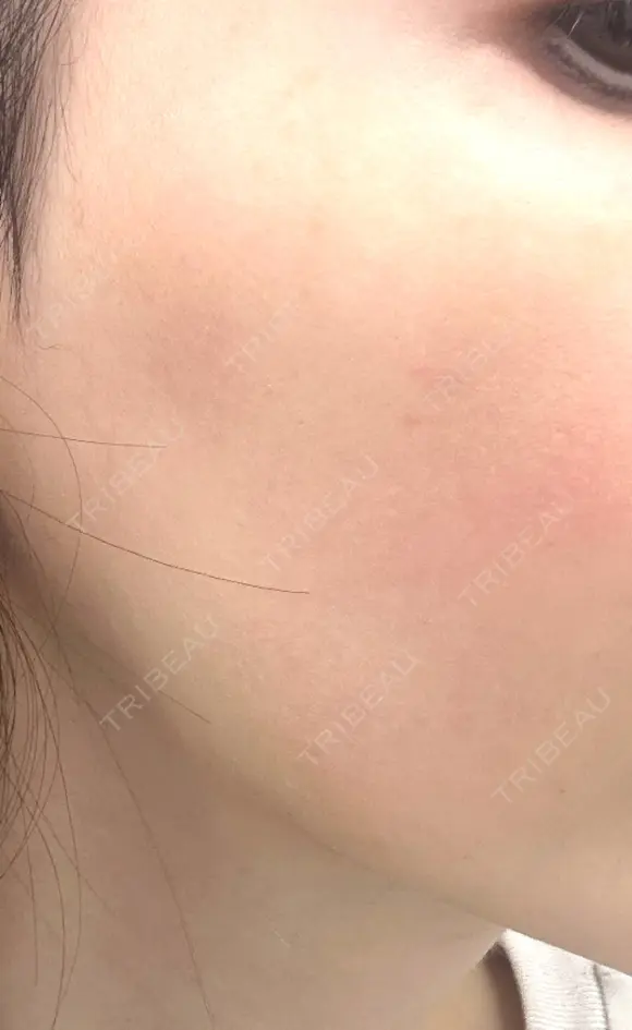 その他（肌） / エレクトロポレーション 湘南美容クリニック 静岡院 DAY 58 メイン用