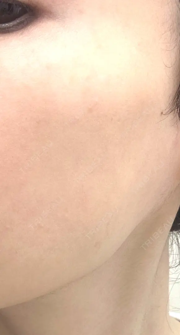 その他（肌） / エレクトロポレーション 湘南美容クリニック 静岡院 DAY 58 メイン用