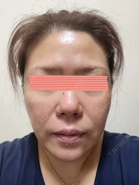 ダーマペン RAISE CLINIC 【レイズクリニック】 DAY 5 メイン用