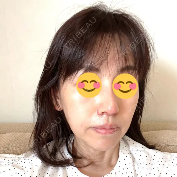 鼻尖形成（切開） / 鼻中隔延長（切開） / 小鼻縮小（切開） / 鼻尖縮小 グローバルビューティークリニック 東京院 DAY 14 メイン用