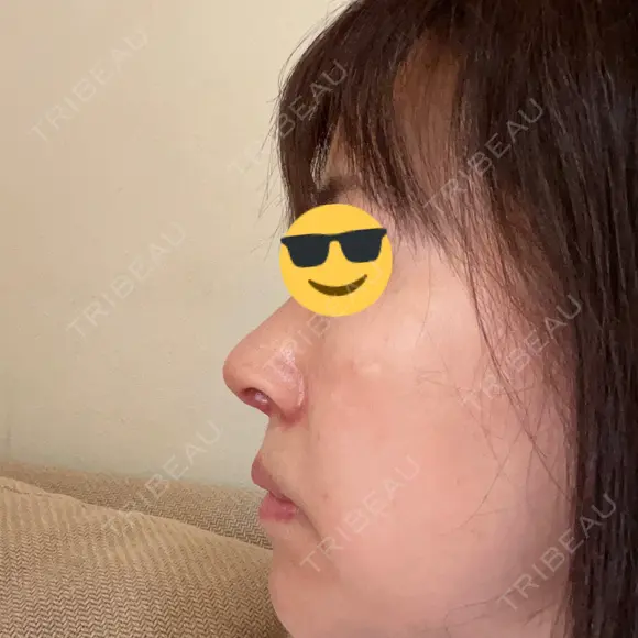鼻尖形成（切開） / 鼻中隔延長（切開） / 小鼻縮小（切開） / 鼻尖縮小 グローバルビューティークリニック 東京院 DAY 14 メイン用
