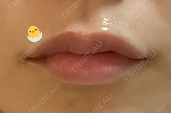 ボトックス（あご） / ボトックス（口角） / ボトックス（肩） / ボトックス（人中） EMMO FACE CLINIC 大宮院 AFTER メイン用
