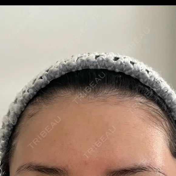 脂肪注入（額） S.T styleクリニック DAY 29 メイン用