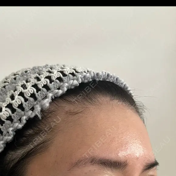 脂肪注入（額） S.T styleクリニック DAY 29 メイン用