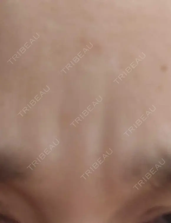 ボトックス（眉間） TCB東京中央美容外科 新横浜院 DAY 26 メイン用