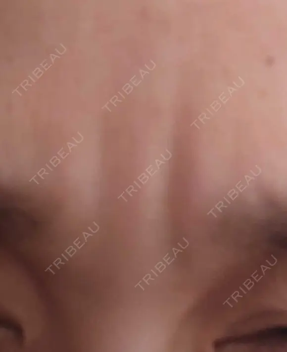 ボトックス（眉間） TCB東京中央美容外科 新横浜院 DAY 27 メイン用