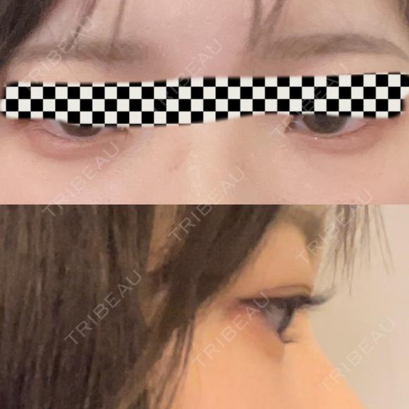ヒアルロン酸注入（涙袋） NARU Beauty Clinic 【ナルクリ】 DAY 0 メイン用