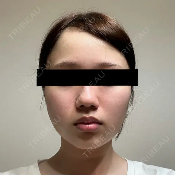 糸リフト / バッカルファット除去 SEA CLINIC（シークリニック） DAY 9 メイン用