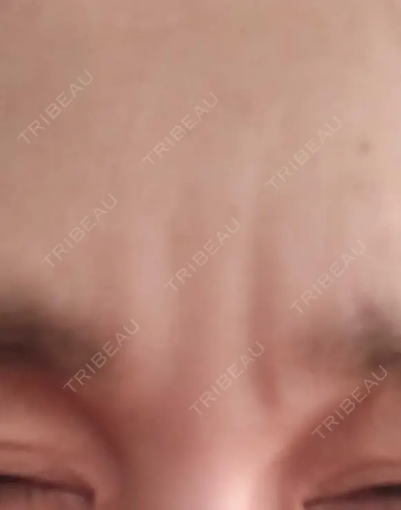 ボトックス（眉間） TCB東京中央美容外科 新横浜院 DAY 28 メイン用