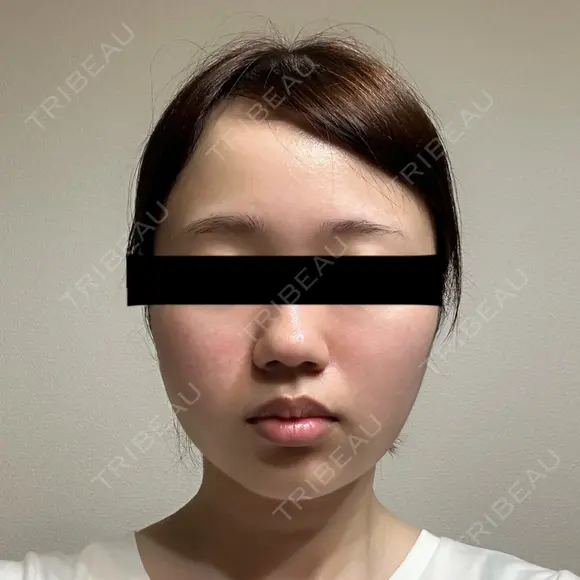 糸リフト / バッカルファット除去 SEA CLINIC（シークリニック） DAY 10 メイン用