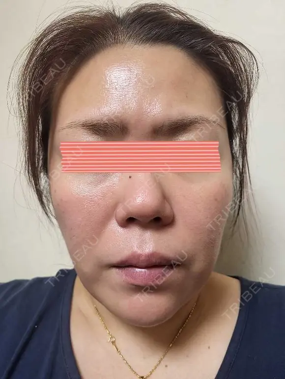 ダーマペン RAISE CLINIC 【レイズクリニック】 AFTER メイン用