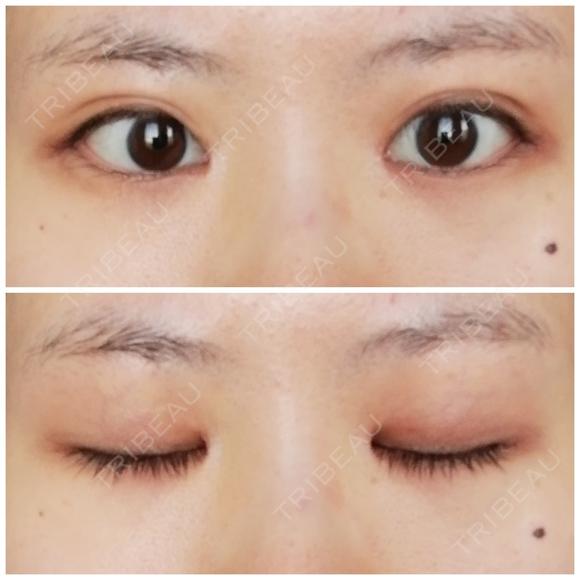 目頭切開 / 目尻切開 / 水光注射（ハリ・美肌） エートップ美容整形外科 AFTER メイン用
