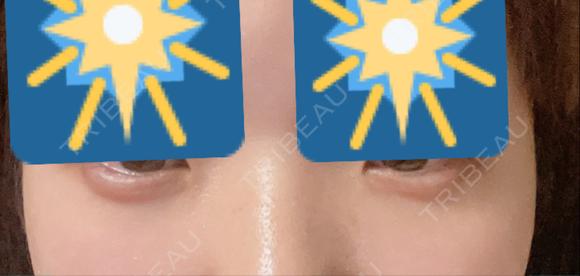 ヒアルロン酸注入（涙袋） NARU Beauty Clinic 【ナルクリ】 AFTER メイン用