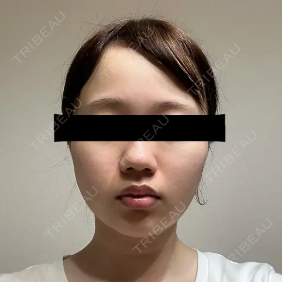 糸リフト / バッカルファット除去 SEA CLINIC（シークリニック） DAY 12 メイン用