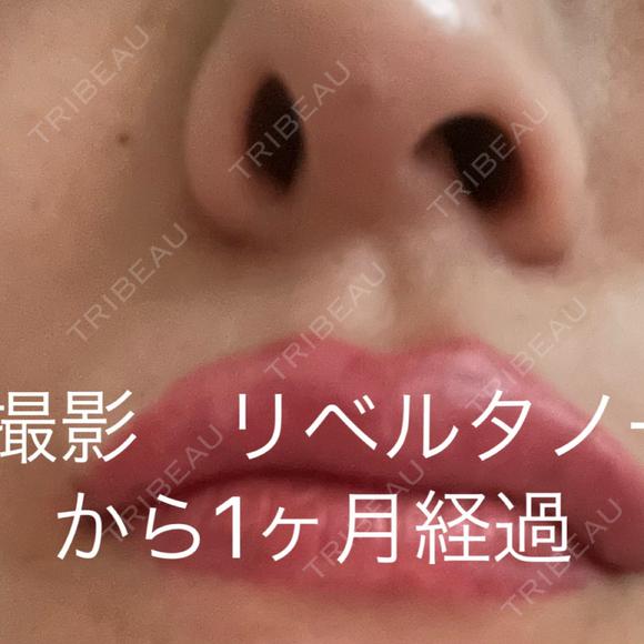 その他（鼻） / 鼻尖縮小 / 肌ヒアルロン酸注入（たるみ・シワ改善） / ヒアルロン酸注入（唇） / シワ取りボトックス / ヒアルロン酸注入（ほうれい線） 東京形成美容外科 船橋院 AFTER メイン用