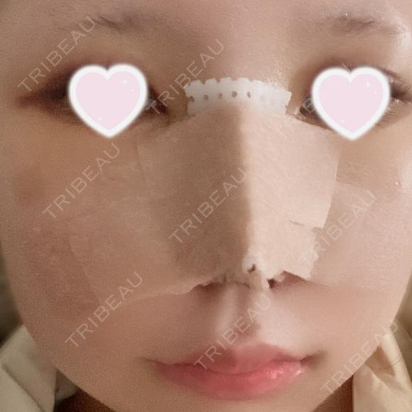 隆鼻術 / 鼻尖形成（切開） / 小鼻縮小（切開） / 軟骨移植 ASTRA BEAUTY CLINIC DAY 3 メイン用