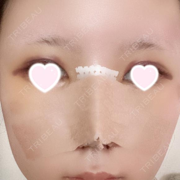 隆鼻術 / 鼻尖形成（切開） / 小鼻縮小（切開） / 軟骨移植 ASTRA BEAUTY CLINIC DAY 4 メイン用