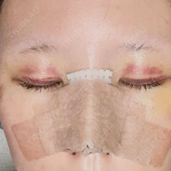 隆鼻術 / 鼻尖形成（切開） / 小鼻縮小（切開） / 軟骨移植 ASTRA BEAUTY CLINIC DAY 5 メイン用