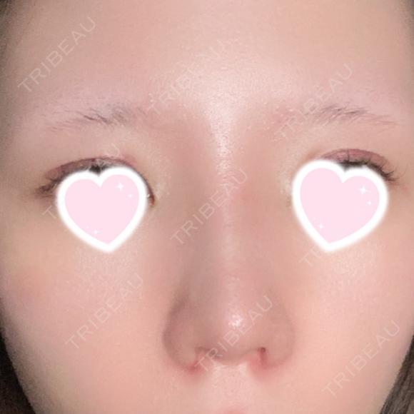 隆鼻術 / 鼻尖形成（切開） / 小鼻縮小（切開） / 軟骨移植 ASTRA BEAUTY CLINIC DAY 10 メイン用