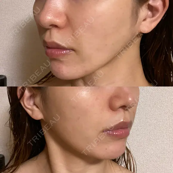 糸リフト / 脂肪吸引注射（顔） 湘南美容クリニック 名古屋栄院 DAY 79 メイン用