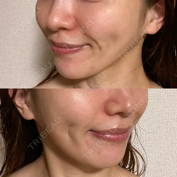 糸リフト / 脂肪吸引注射（顔） 湘南美容クリニック 名古屋栄院 DAY 79 メイン用