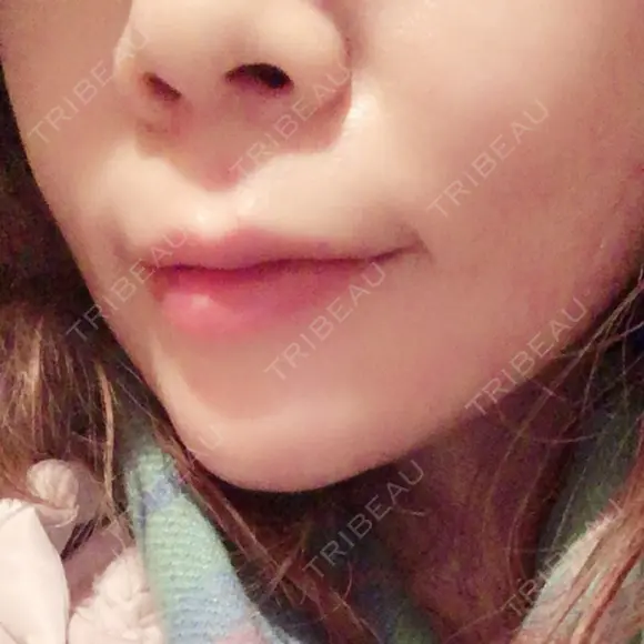 ヒアルロン酸注入（あご） TCB東京中央美容外科 世田谷院 DAY 2 メイン用