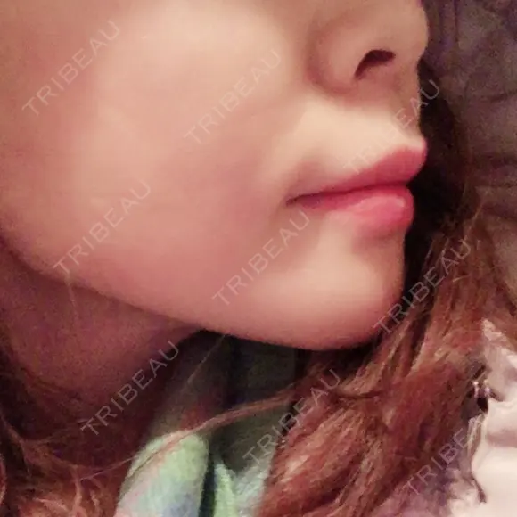 ヒアルロン酸注入（あご） TCB東京中央美容外科 世田谷院 DAY 2 メイン用