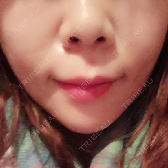 ヒアルロン酸注入（あご） TCB東京中央美容外科 世田谷院 DAY 2 メイン用