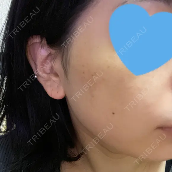 光治療（フォトフェイシャルなど） メディアージュクリニック 名古屋院 DAY 3 メイン用