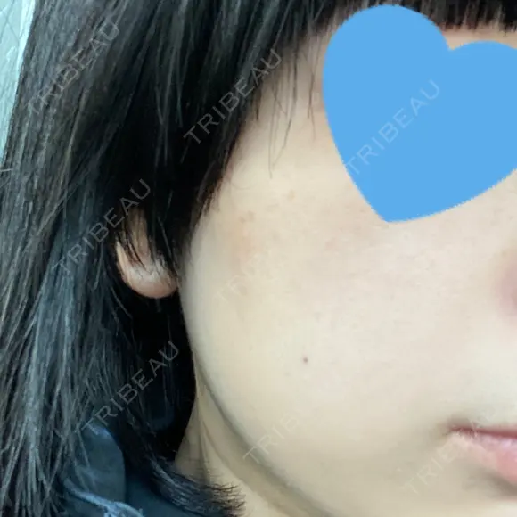 光治療（フォトフェイシャルなど） メディアージュクリニック 名古屋院 DAY 4 メイン用