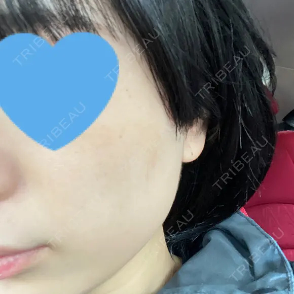 光治療（フォトフェイシャルなど） メディアージュクリニック 名古屋院 DAY 4 メイン用