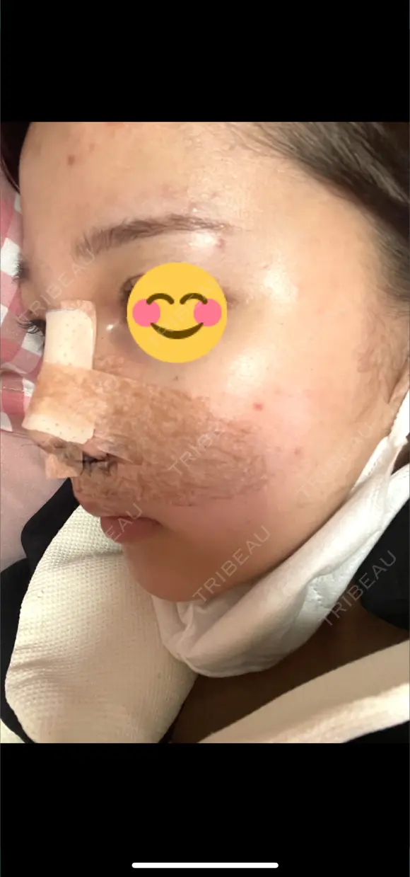 鼻尖形成（切開） / 小鼻縮小（切開） / 軟骨移植 / 鼻柱下降・鼻唇角形成（猫手術） / ヒアルロン酸注入（あご） グローバルビューティークリニック 東京院 DAY 0 メイン用