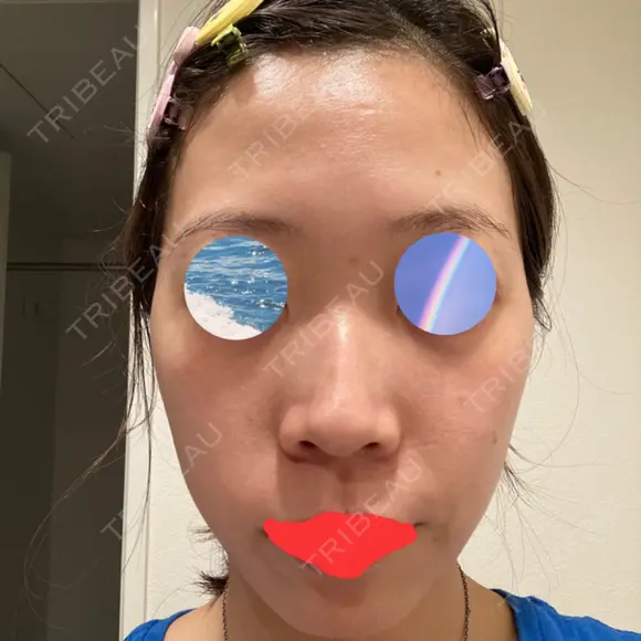ルメッカ ルラ美容クリニック 渋谷本院 AFTER メイン用