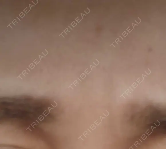 ボトックス（眉間） TCB東京中央美容外科 新横浜院 DAY 33 メイン用