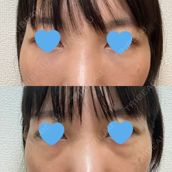 クマ治療 / 下まぶたたるみ取り / 下まぶたの脂肪取り / 脂肪注入（目の下） お茶の水美容形成クリニック AFTER メイン用