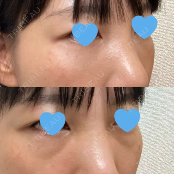 クマ治療 / 下まぶたたるみ取り / 下まぶたの脂肪取り / 脂肪注入（目の下） お茶の水美容形成クリニック DAY 33 メイン用